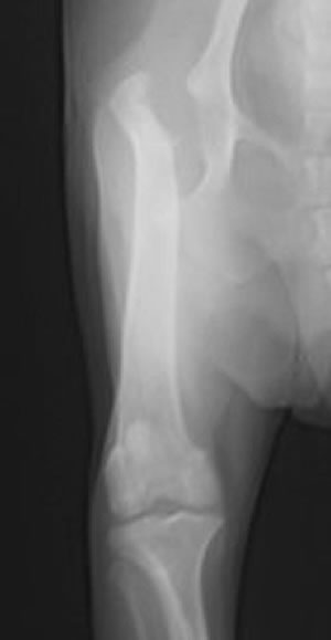 無菌性大腿骨頭壊死症、股関節脱臼